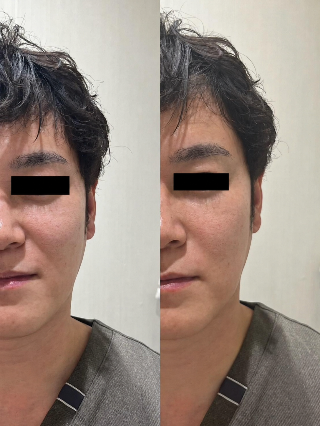 30代男性のほうれい線 使用前と片側5プッシュ30秒後の比較写真