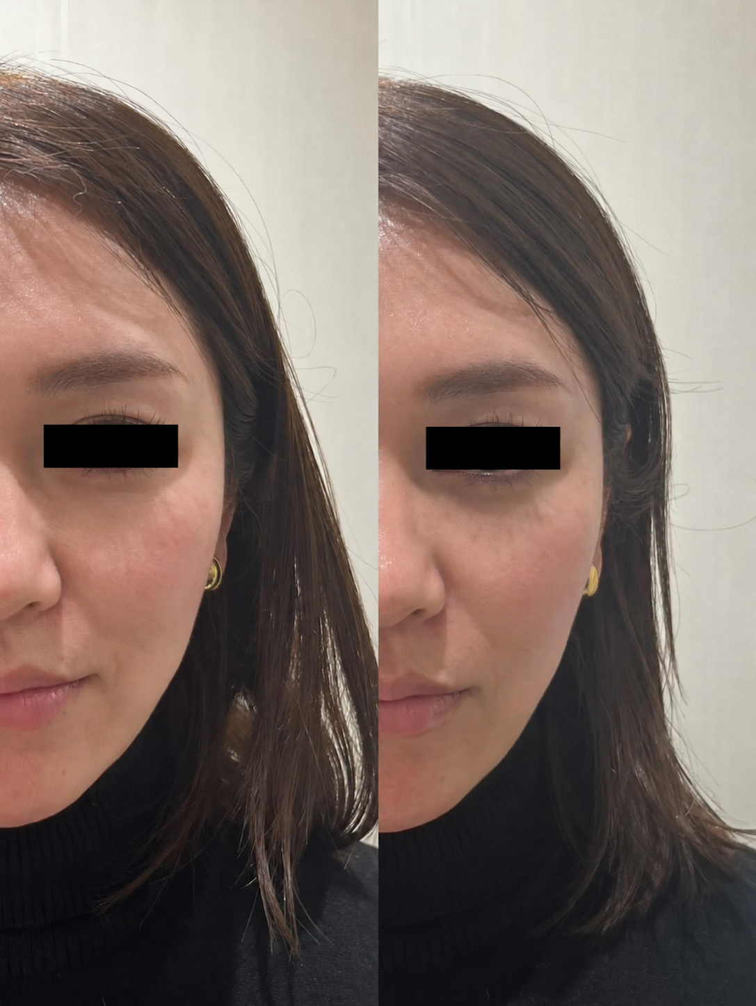 30代女性の顎のライン 使用前と片側5プッシュ30秒後の比較写真