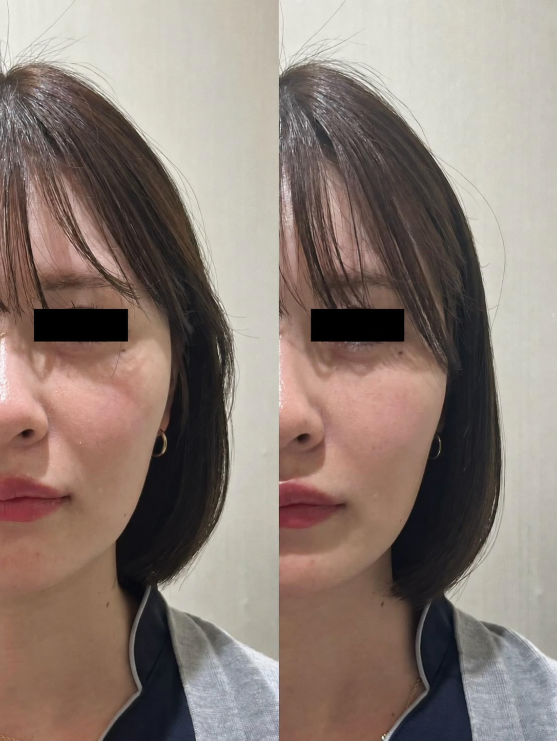 20代女性のほうれい線と頬ライン 使用前と片側5プッシュ30秒後の比較写真